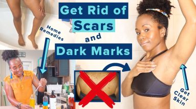 Get Rid of Hyperpigmentation, Scars, Dark Spots & Boil Scars on Your Body FAST | *Highly Requested* 6 1680712155 maxresdefault