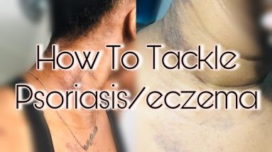 Psoriasis/eczema Breakouts ? What To Do | Gabbybaddd Curly 12 1680715990 maxresdefault