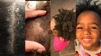 1 Month Update on Toddlers Eczema| NATURAL HAIR 4 1680717665 maxresdefault