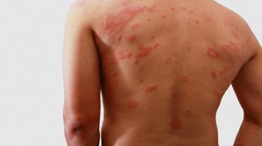 Eczema Symptoms And Causes. 20 1680718863 maxresdefault