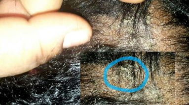 Fungus and dry scalp issues in 2yr old hair 14 1680721126 maxresdefault
