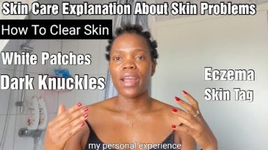 How To Repair Bleaching Skin,White Patches,Eczema Dark knuckles (Skin Care Problems Explanation) 12 1680727576 hqdefault