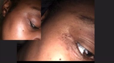How I cured my Eczema around my eyes in a week 18 1680731238 hqdefault