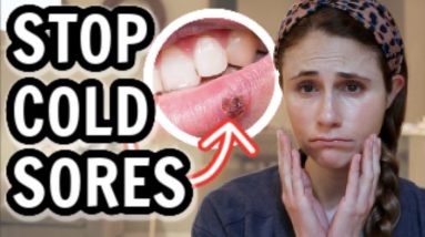 How to treat cold sores FAST| Dr Dray 12 1680733238 maxresdefault