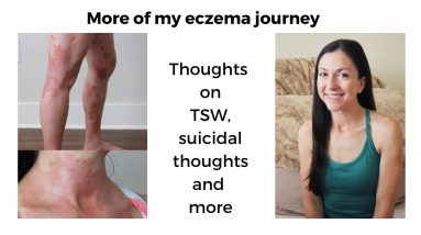 Eczema and topical steroid withdrawal (TSW) | My experience 6 1680740291 maxresdefault