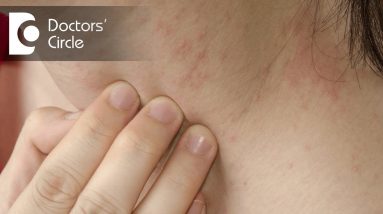 How to identify scabies rash & its management? - Dr. Sudheendra Udbalker 16 1680748062 maxresdefault