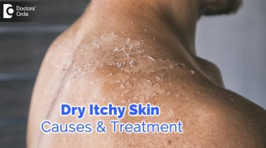 Dry itchy skin all over body. Causes, Diagnosis, Treatment - Dr. Rashmi Ravindra | Doctors' Circle 2 1680751716 maxresdefault