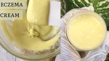 HOW TO GET RID OF ECZEMA | HOMEMADE ECZEMA CREAM | Relief for dry and itchy skin | DIY eczema cream 6 1680755925 maxresdefault