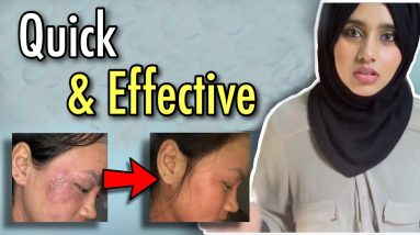 HOW TO REDUCE ECZEMA 20 1680757793 maxresdefault