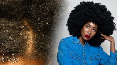 Your Hair Won’t GROW: You Have SCALP FUNGUS (Eliminate DANDRUFF + DRY/ITCHY SCALP) | EfikZara 14 1680759229 maxresdefault