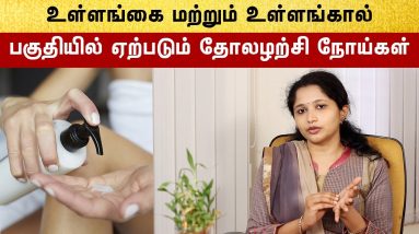 How To Treat Hand And Leg Eczema problems | எக்ஸிமா தோலழற்சி நோய் ஏற்பட காரணம் 10 1680760400 maxresdefault