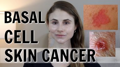 BASAL CELL SKIN CANCER: WHAT YOU SHOULD KNOW| DR DRAY 20 1680762987 maxresdefault