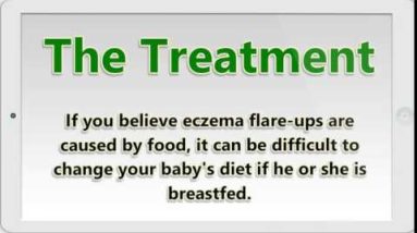 Baby Eczema What You Need To Know about Baby Eczema 16 1680764240 hqdefault