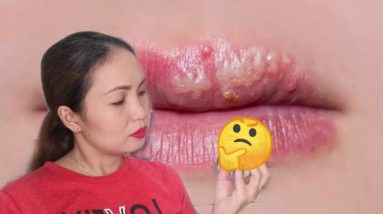 PINAKAMABISANG GAMOT SA HERPES (Cold Sore) || Cold Sore Causes, Prevention and Cure || Teacher Weng 12 1680770676 maxresdefault
