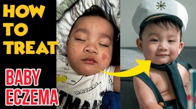 How to treat BABY ECZEMA 100% Effective! 12 1680775689 maxresdefault