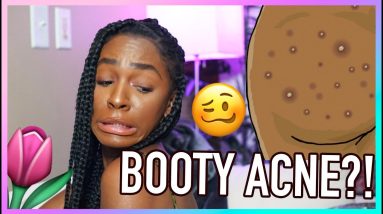V-Talk 🌷 How To Do A BUTT FACIAL! Getting Rid of Booty Acne, Scars, and Irritation! 10 1680781777 maxresdefault