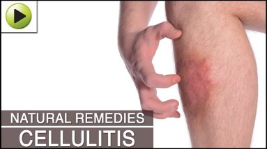 Home Remedies for Cellulitis 14 1680796642 maxresdefault
