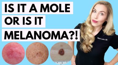 Is It A Mole or Melanoma? This Might Save Your Life! | Dermatologist Tips 4 1680799512 maxresdefault