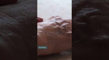 Calendula For Eczema 💯🏵️ #shorts #short #youtubeshorts 16 1680801537 maxresdefault