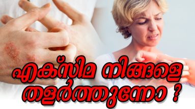 എക്സിമ നിങ്ങളെ തളർത്തുന്നോ Healthy kerala | Skin care | Skin tips | Eczema care | Skin | Beauty 12 1680802656 maxresdefault