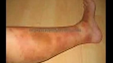 Eczema - What Is It? 10 1680803236 hqdefault