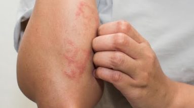 8 Root Causes Of Eczema Doctors Never Treat 4 1680810130 hqdefault