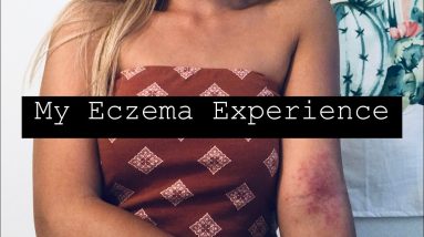 My Experience & Advice On Eczema 4 1680820664 maxresdefault