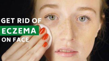 5 Best Ways to Deal with Eczema on Face! 2 1680821336 maxresdefault