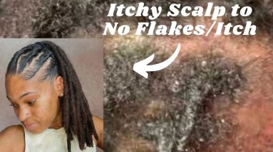 Wash Day | What I Use For Seborrheic Dermatitis + Quick Loc Style | Watch For A Message!!!! 20 1680821765 maxresdefault