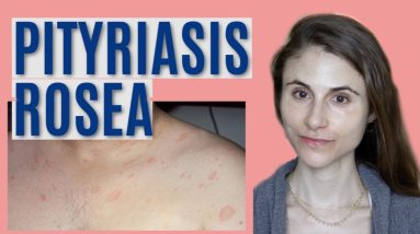 PITYRIASIS ROSEA: WHAT IT IS & GETTING RID OF IT| DR DRAY 2 1680826443 maxresdefault