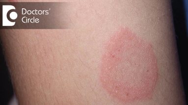 How to manage Chronic Ringworm infection? - Dr. Rajdeep Mysore 10 1680829708 maxresdefault