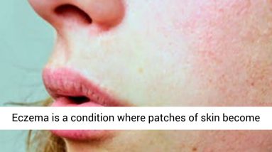 Eczema Natural Healing Solutions Video Series Introduction 4 1680831374 maxresdefault