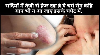 एक्जिमा क्या होता है? जाने इसके लक्षण और इससे बचने के उपाय. 18 1680832702 maxresdefault