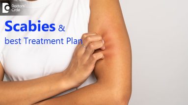 Itching & rashes on Skin- Is it Scabies?Symptoms, Causes & Treatment- Dr. Nischal K |Doctors' Circle 16 1680833543 maxresdefault