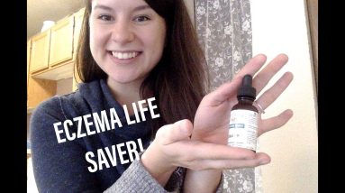 WHAT HELPS ECZEMA? THIS IS A LIFE SAVER! IT MAY JUST CHANGE YOUR LIFE!!! 4 1680836588 maxresdefault