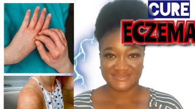 ECZEMA TREATMENT || HOW TO GET RID OF SKIN ECZEMA ||#ECZEMA 12 1680840008 maxresdefault