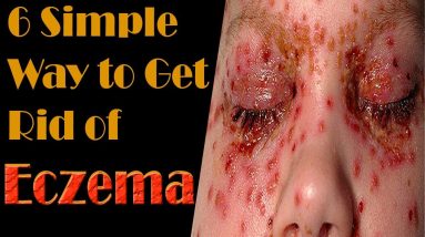 6 Simple Way To Get Rid of Eczema | How To Get Rid of Eczema 2 1680842668 maxresdefault