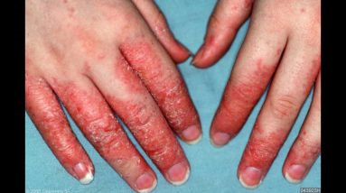 NATURAL Eczema Cure & Remedy!!! How to GET RID of Dry Hands! 10 1680851112 maxresdefault