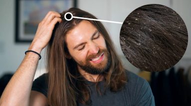 What Do Flakes In Your Hair REALLY Mean? (Dandruff From Itchy Dry Scalp Vs Seborrheic Dermatitis) 20 1680858642 maxresdefault