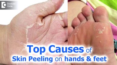 Skin Peeling on hands & feet - Causes & Treatment Dr. Rajdeep Mysore 16 1680859937 maxresdefault