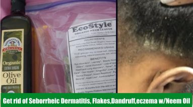 How I control my seborrheic dermatitis, dandruff, flakes ,eczema with Neem Oil. This is Amazing. 2 1680869133 maxresdefault