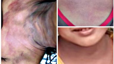 ALL YOU NEED TO KNOW ABOUT ECZEMA / Atopic Dermatitis | My 6 Year Journey to become Rash/Itch-Free 2 1680879592 maxresdefault