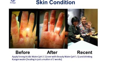 Kangen Water & Eczema, Psoriasis Causes & Symptoms - Youtube 4 1680884297 maxresdefault