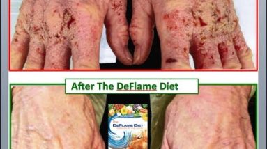 Bloody eczema and chronic pain GONE after anti-inflammatory diet (The DeFlame Diet) 20 1680886073 hqdefault