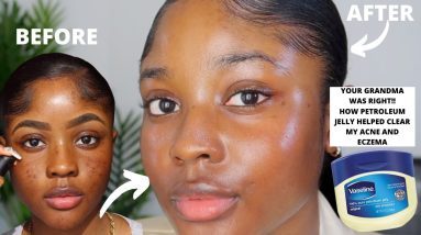 HOW VASELINE HELPED CLEAR MY ACNE AND EZCEMA FASTER!! | KAISERCOBY 14 1680886899 maxresdefault