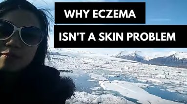 Why Your Eczema Isn't a Skin Problem (Discover The Iceberg Analogy) 18 1680897402 maxresdefault