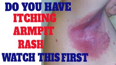 Skin Rash | How To Get Rid Of Rash Under Armpit | Heat Rash | Eczema | Atopic Dermatitis | itchy 16 1680897532 maxresdefault