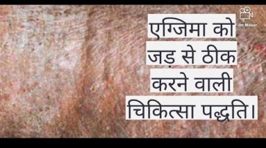Eczema#Atopic Dermatitis#Eczema को जड़ से खत्म कैसे करें? 8 1680899055 hqdefault