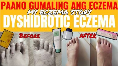 PAANO GAMUTIN ANG ECZEMA|My eczema story (Dyshidrotic Eczema) 8 1680904895 maxresdefault