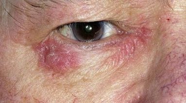 How to Treat Eczema Around the Eyes - Eczema Around the Eyes Treatment 6 1680910211 hqdefault